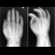 Minus variant of ulna, intraarticular fracture of proximal phalanx of fifth finger: X-ray - Plain radiograph